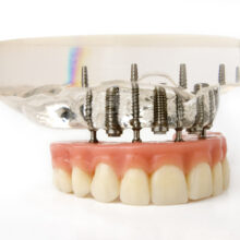 Protesi implantare