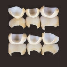 Faccette Dentali
